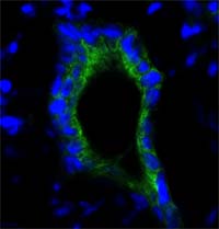 photo of Tn-MUC1 in colonic cancer cell